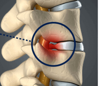Disc bulge, bulging disc, disc pain